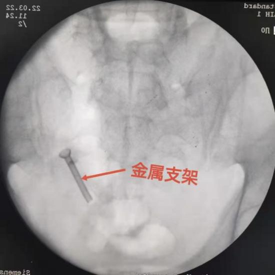 新型热膨胀镍钛记忆合金输尿管支架是兰大二院开展的新技术,这是一种